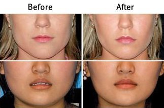 Botox for Jaw line reduction